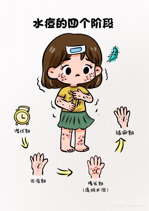 水痘.jpg
